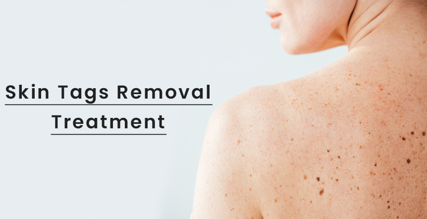 Skin tags Removal Treatment